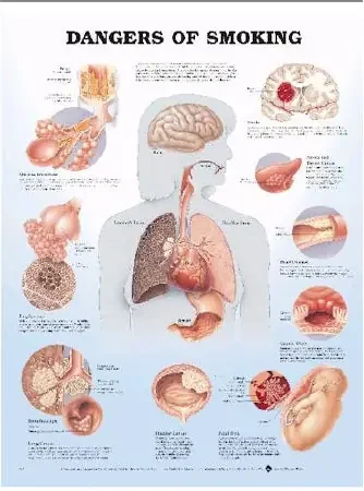 Anatomical Chart Company Anatomical Chart Dangers of Smoking 20 X 26 Inch Plastic Wall Mount Laminated – 9781587792311