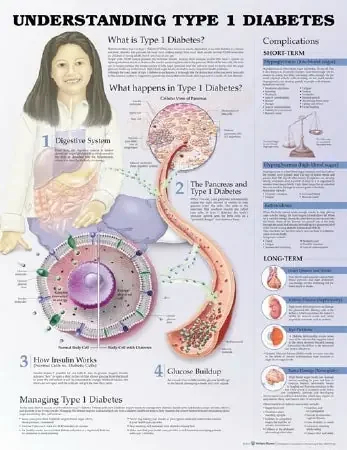 Anatomical Chart Company Anatomical Chart Type 1 Diabetes 3rd Edition 20 X 26 Inch Heavy Paper Grommets Laminated – 9781469894935
