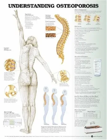 Anatomical Chart Company Anatomical Chart Understanding Osteoporosis 20 X 26 Inch Plastic Grommets Laminated – 9781496362483