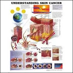 Anatomical Chart Company Anatomical Chart Understanding Skin Cancer 20 X 26 Inch Heavy Paper Laminated – 9781605470948