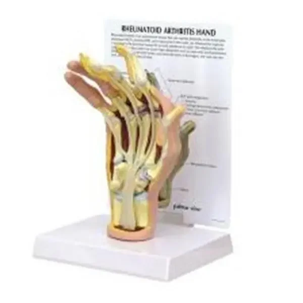 Wards Natural Science Model Rheumatoid Arthritis Hand Gpi Anatomicals Ea – 470160-248