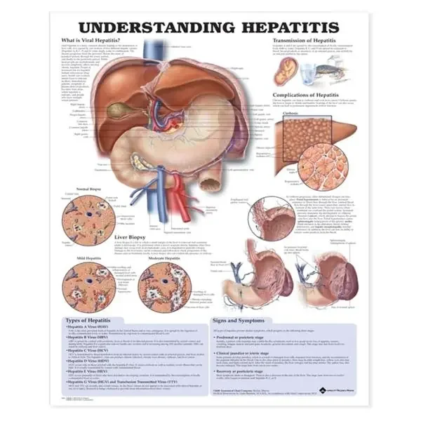 Wolters Kluwer Health Inc Chart Educational Understanding Hepatitis 20X26″ Ea – 9781587794186